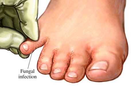 Picture of interdigital athlete's foot