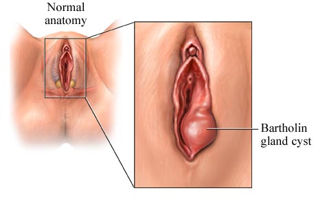 Bartholin gland cyst and normal anatomy
