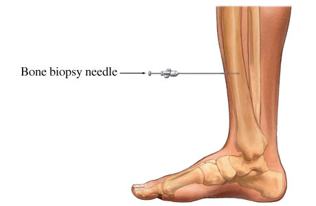 Bone biopsy: closed