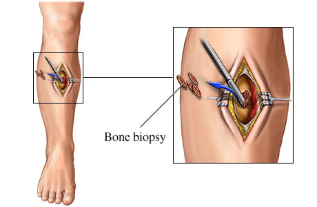 Bone biopsy: open