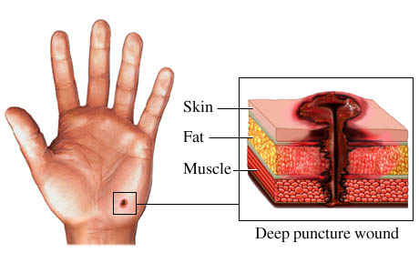 Picture of a puncture wound