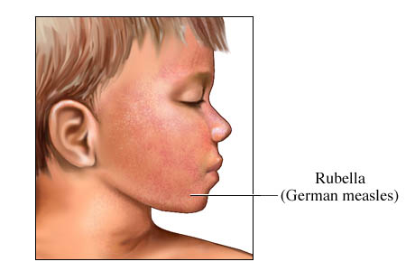 Rubella (German measles) rash