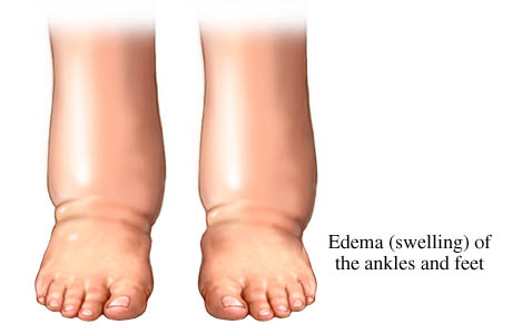 Pedal edema