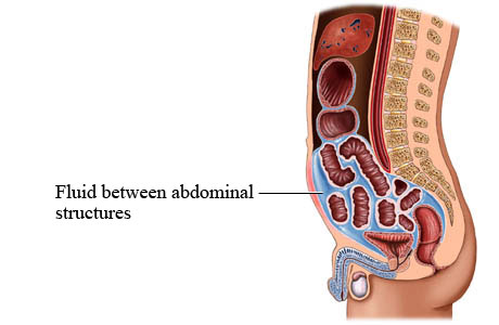 Ascites