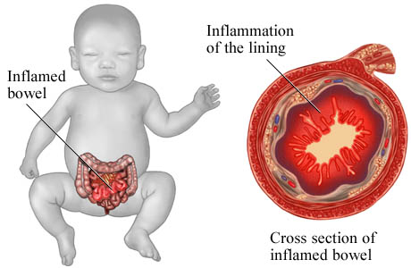 Necrotizing enterocolitis