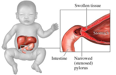 Pyloric stenosis