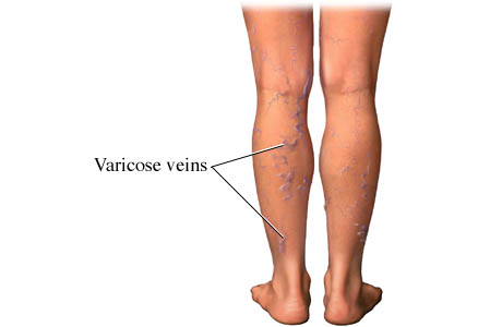 Picture of varicose veins: external view