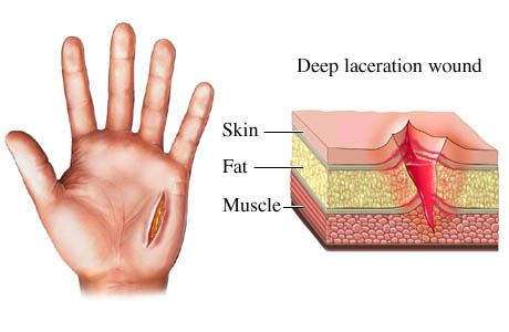 Picture of a skin laceration