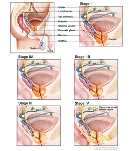 Prostate cancer staging; six panel drawing showing a side view of normal male anatomy and closeup views of Stage I, Stage IIA, Stage IIB, Stage III, and Stage IV showing cancer growing from within the prostate to nearby tissue and then to lymph nodes or other parts of the body.