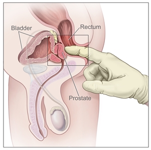Digital rectal exam; drawing shows a side view of the male reproductive and urinary anatomy, including the prostate, rectum, and bladder; also shows a gloved and lubricated finger inserted into the rectum to feel the prostate.