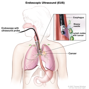 Endoscopic ultrasound-guided fine-needle aspiration biopsy; drawing shows an endoscope with an ultrasound probe and biopsy needle inserted through the mouth and into the esophagus. Drawing also shows lymph nodes near the esophagus and cancer in one lung. Inset shows the ultrasound probe locating the lymph nodes with cancer and the biopsy needle removing tissue from one of the lymph nodes near the esophagus.