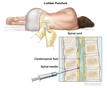 Lumbar puncture; drawing shows a patient lying in a curled position on a table and a spinal needle (a long, thin needle) being inserted into the lower back. Inset shows a close-up of the spinal needle inserted into the cerebrospinal fluid (CSF) in the lower part of the spinal column.