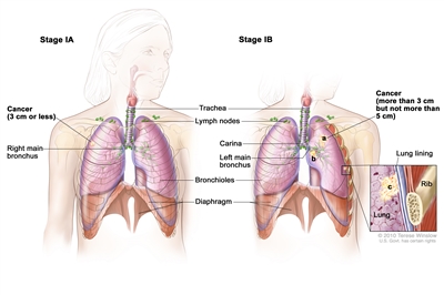 Two-panel drawing of stage I non-small cell lung cancer. First panel shows stage IA with cancer (3 cm or less) in the right lung; also shown are the right main bronchus, trachea, lymph nodes, bronchioles, and diaphragm. Second panel shows stage IB with cancer (more than 3 cm but not more than 5 cm) in the left lung and in the left main bronchus; the carina is also shown. Inset shows cancer that has spread from the lung into the innermost layer of the lung lining; a rib is also shown.