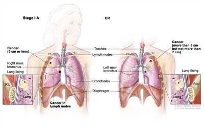 Two-panel drawing of stage IIA non-small cell lung cancer. First panel shows cancer (5 cm or less), and cancer in the right main bronchus and lymph nodes; also shown are the trachea, bronchioles, and diaphragm. Second panel shows cancer (more than 5 cm but not more than 7 cm), and cancer in the left main bronchus; also shown are the trachea, lymph nodes, bronchioles, and diaphragm. Insets show cancer that has spread from the lung into the innermost layer of the lung lining; a rib is also shown.