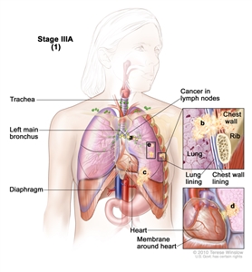 Stage IIIA non-small cell lung cancer (1). Drawing shows cancer in lymph nodes, left main bronchus, and diaphragm; there may be separate tumors in the same lung; the trachea is also shown. Top inset shows cancer that has spread from the lung through the lung lining and chest wall lining into the chest wall; a rib is also shown. Bottom inset shows the heart and cancer that has spread from the lung into the membrane around the heart.