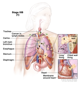 Stage IIIB non-small cell lung cancer (1). Drawing shows cancer in lymph nodes above the collarbone on the opposite side of the chest as the primary tumor, and in the trachea, carina, left main bronchus, esophagus, sternum, diaphragm, and major blood vessels that lead to or from the heart; there may be separate tumors in the same lung. Top inset shows cancer that has spread from the lung, through the lung lining and chest wall lining, into the chest wall; a rib is also shown. Bottom inset shows cancer that has spread from the lung, through the membrane around the heart, into the heart.
