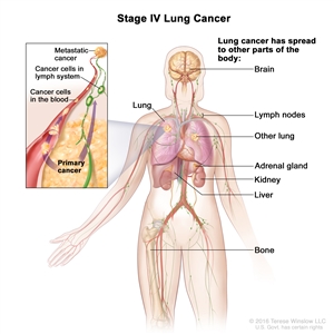 Stage IV non-small cell lung cancer; drawing shows other parts of the body where lung cancer may spread, including the other lung, brain, lymph nodes, adrenal gland, kidney, liver, and bone. An inset shows cancer cells spreading from the lung, through the blood and lymph system, to another part of the body where metastatic cancer has formed.