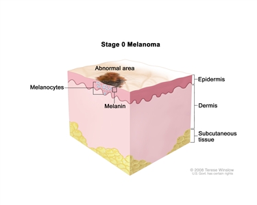 Stage 0 melanoma in situ; drawing shows skin anatomy with an abnormal area on the surface of the skin. Both normal and abnormal melanocytes and melanin are shown in the epidermis (outer layer of the skin). Also shown are the dermis (inner layer of the skin) and the subcutaneous tissue below the dermis.