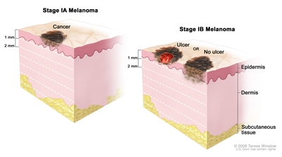 Two-panel drawing of stage I melanoma. The first panel shows a stage IA tumor that is not more than 1 millimeter thick, with no ulceration (break in the skin). The second panel shows two stage IB tumors. One tumor is not more than 1 millimeter thick, with ulceration, and the other tumor is more than 1 but not more than 2 millimeters thick, with no ulceration. Also shown are the epidermis (outer layer of the skin), the dermis (inner layer of the skin), and the subcutaneous tissue below the dermis.
