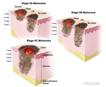 Three-panel drawing of stage II melanoma. The left panel shows two stage IIA tumors. One tumor is more than 1 but not more than 2 millimeters thick, with ulceration (break in the skin); the other tumor is more than 2 but not more than 4 millimeters thick, with no ulceration. The right panel shows two stage IIB tumors. One tumor is more than 2 but not more than 4 millimeters thick, with ulceration; the other tumor is more than 4 millimeters thick, with no ulceration. The bottom panel shows a stage IIC tumor that is more than 4 millimeters thick, with ulceration. Also shown are the epidermis (outer layer of the skin), the dermis (inner layer of the skin), and the subcutaneous tissue below the dermis.