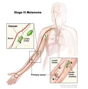 Stage III melanoma; drawing shows a primary tumor on the lower arm. In the top inset, cancer is shown (a) in lymph nodes near a blood vessel. In the bottom inset, cancer is shown (b) in lymph nodes that are joined together (matted), (c) in a lymph vessel, and (d) not more than 2 centimeters away from the primary tumor.