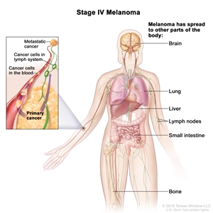 Stage IV melanoma; drawing shows other parts of the body where melanoma may spread, including the brain, lung, liver, lymph nodes, small intestine, and bone. An inset shows cancer cells spreading through the blood and lymph system to another part of the body where metastatic cancer has formed.