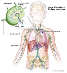 Stage IIE childhood Hodgkin lymphoma; drawing shows cancer in one lymph node group above the diaphragm and in the left lung. An inset shows a lymph node with a lymph vessel, an artery, and a vein. Lymphoma cells containing cancer are shown in the lymph node.