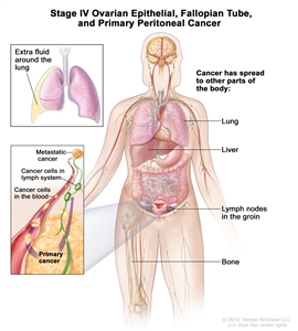 Drawing of stage IV shows other parts of the body where ovarian cancer, fallopian tube cancer, and primary peritoneal cancer may spread, including the lung, liver, bone, and lymph nodes in the groin. An inset on the top shows extra fluid around the lung. An inset on the bottom shows cancer cells spreading through the blood and lymph system to another part of the body where metastatic cancer has formed.