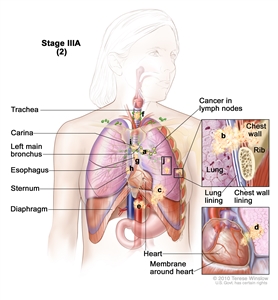 Stage IIIA lung cancer (2). Drawing shows cancer in the lymph nodes, trachea, carina, left main bronchus, esophagus, sternum, diaphragm, and major blood vessels that lead to or from the heart; there may be separate tumors in the same lung. Top inset shows cancer that has spread from the lung through the lung lining and chest wall lining into the chest wall; a rib is also shown. Bottom inset shows cancer that has spread from the lung, through the membrane around the heart, into the heart.