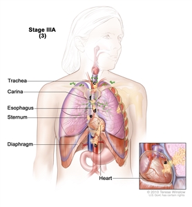 Stage IIIA non-small cell lung cancer (3). Drawing shows cancer in the heart, major blood vessels that lead to or from the heart, the trachea, esophagus, sternum, and carina; the diaphragm is also shown. Inset shows cancer that has spread from the lung, through the membrane around the heart, into the heart.