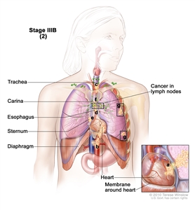 Stage IIIB non-small cell lung cancer (2). Drawing shows cancer in lymph nodes on the same side of the chest as the primary tumor, in the heart, major blood vessels that lead to or from the heart, the trachea, esophagus, sternum, carina, and in separate tumors in different lobes of the same lung; the diaphragm is also shown. Inset shows cancer that has spread from the lung, through the membrane around the heart, into the heart.