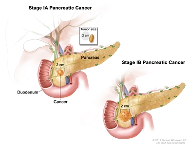 Stage I pancreatic cancer; drawing on the left shows that stage IA pancreatic cancer is smaller than 2 centimeters. The drawing on the right shows that stage IB pancreatic cancer is larger than 2 centimeters. An inset shows that a 2 centimeter tumor is about the size of a peanut. The duodenum is also shown.
