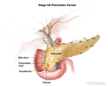 Stage IIA pancreatic cancer; drawing shows cancer in the pancreas and duodenum. The bile duct and pancreatic duct are also shown.