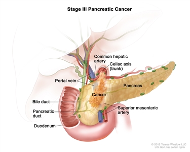 Stage III pancreatic cancer; drawing shows cancer in the pancreas, common hepatic artery, and portal vein. Also shown are the celiac axis (trunk), bile duct, pancreatic duct, duodenum, and superior mesenteric artery.