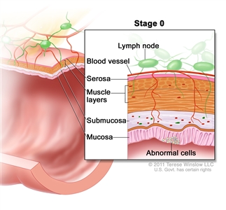 Stage 0 colon/rectal carcinoma in situ; shows a cross-section of the colon/rectum. An inset shows the layers of the colon/rectum wall with abnormal cells in the mucosa layer. Also shown are the submucosa, muscle layers, serosa, a blood vessel, and lymph nodes.