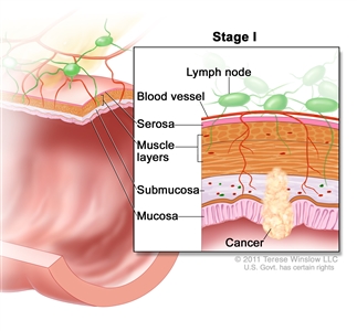 Stage I colorectal cancer; shows a cross-section of the colon/rectum. An inset shows the layers of the colon/rectum wall with cancer in the mucosa, submucosa, and muscle layers. Also shown are the serosa, a blood vessel, and lymph nodes.