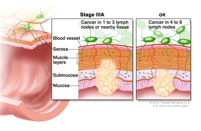 Stage IIIA colorectal cancer; shows a cross-section of the colon/rectum and a two-panel inset. Each panel shows the layers of the colon/rectum wall: mucosa, submucosa, muscle layers, and serosa. Also shown are a blood vessel and lymph nodes. First panel shows cancer in the mucosa, submucosa, muscle layers, and 2 lymph nodes. Second panel shows cancer in the mucosa, submucosa, and 5 lymph nodes.