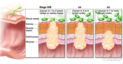 Stage IIIB colorectal cancer; shows a cross-section of the colon/rectum and a two-panel inset. Each panel shows the layers of the colon/rectum wall: mucosa, submucosa, muscle layers, and serosa. Also shown are a blood vessel and lymph nodes. First panel shows cancer in all layers, spreading through the serosa, and in 3 lymph nodes. Second panel shows cancer in all layers and in 5 lymph nodes. Third panel shows cancer in the mucosa, submucosa, muscle layers, and 7 lymph nodes.