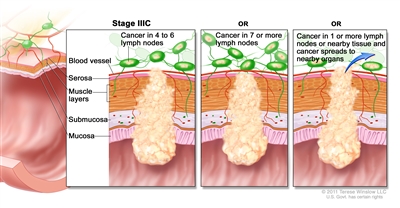 Stage IIIC colorectal cancer; shows a cross-section of the colon/rectum wall and a three-panel inset. Each panel shows the layers of the colon/rectum wall: mucosa, submucosa, muscle layers, and serosa. Also shown are a blood vessel and lymph nodes. First panel shows cancer in all layers, spreading through the serosa, and in 4 lymph nodes. Second panel shows cancer in all layers and in 7 lymph nodes. Third panel shows cancer in all layers, spreading through the serosa, in 2 lymph nodes, and spreading to nearby organs.