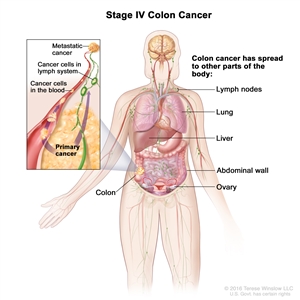 Stage IV colon cancer; drawing shows other parts of the body where colon cancer may spread, including the lymph nodes, lung, liver, abdominal wall, and ovary. An inset shows cancer cells spreading from the colon, through the blood and lymph system, to another part of the body where metastatic cancer has formed.