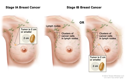 Stage I breast cancer. Drawing shows stage IA on the left; the tumor is 2 cm or smaller and has not spread outside the breast. Drawings in the middle and on the right show stage IB. In the drawing in the middle, no tumor is found in the breast, but small clusters of cancer cells are found in the lymph nodes. In the drawing on the right, the tumor is 2 cm or smaller and small clusters of cancer cells are found in the lymph nodes.