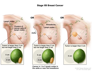 Stage IIB breast cancer. The drawing on the left shows the tumor is larger than 2 cm but not larger than 5 cm and small clusters of cancer cells are in the lymph nodes. The drawing in the middle shows the tumor is larger than 2 cm but not larger than 5 cm and cancer is in 3 axillary lymph nodes. The drawing on the right shows the tumor is larger than 5 cm but has not spread to the lymph nodes.