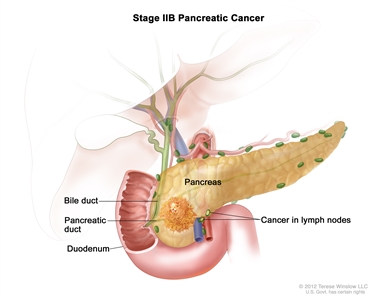 Stage IIB pancreatic cancer; drawing shows cancer in the pancreas and in nearby lymph nodes. Also shown are the bile duct, pancreatic duct, and duodenum.