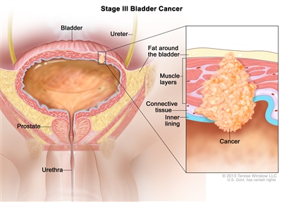 Stage III bladder cancer; drawing shows the bladder, ureter, prostate, and urethra. Inset shows cancer in the inner lining of the bladder, the layer of connective tissue, the muscle layers, and the layer of fat around the bladder.