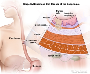Stage IA squamous cell cancer of the esophagus; drawing shows the esophagus and stomach. An inset shows cancer cells in the mucosa and submucosa layers of the esophagus wall. Also shown are the muscle and connective tissue layers of the esophagus wall and lymph nodes.