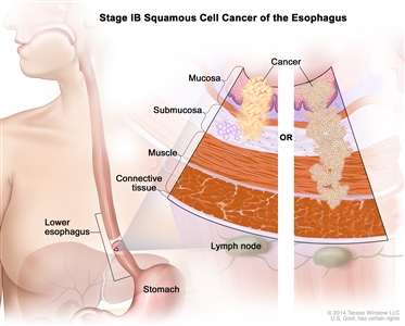 Stage IB squamous cell cancer of the esophagus; drawing shows the esophagus and stomach. A two-panel inset shows the layers of the esophagus wall: the mucosa, submucosa, muscle, and connective tissue layers. Also shown are lymph nodes. The left panel shows cancer in the mucosa and submucosa layers. The right panel shows cancer in the mucosa, submucosa, and muscle layers.
