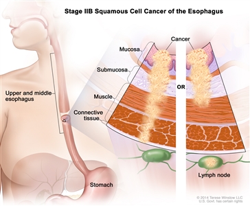 Stage IIB squamous cell cancer of the esophagus; drawing shows the esophagus and stomach. A two-panel inset shows the layers of the esophagus wall: the mucosa, submucosa, muscle, and connective tissue layers. The left panel shows cancer in the mucosa, submucosa, muscle, and connective tissue layers. The right panel shows cancer in the mucosa, submucosa, and muscle layers and in 1 lymph node.