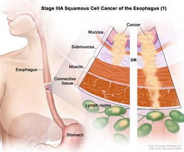 Stage IIIA squamous cell cancer of the esophagus (1); drawing shows the esophagus and stomach. A two-panel inset shows the layers of the esophagus wall: the mucosa, submucosa, muscle, and connective tissue layers. The left panel shows cancer in the mucosa and submucosa layers and in 3 lymph nodes. The right panel shows cancer in the mucosa, submucosa, muscle, and connective tissue layers and in 1 lymph node.