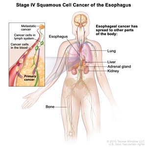 Stage IV squamous cell cancer of the esophagus; drawing shows other parts of the body where esophagus cancer may spread, including the lung, liver, adrenal gland, kidney, and bone. An inset shows cancer cells spreading from the esophagus, through the blood and lymph system, to another part of the body where metastatic cancer has formed.
