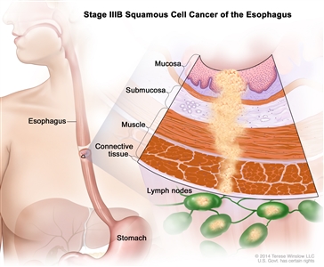 Stage IIIB squamous cell cancer of the esophagus; drawing shows the esophagus and stomach. An inset shows the layers of the esophagus wall with cancer in the mucosa, submucosa, muscle, and connective tissue layers. Also shown is cancer in 4 lymph nodes.